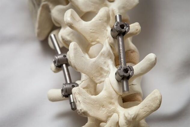 osteochondrosis spine an mhuineál a shocrú