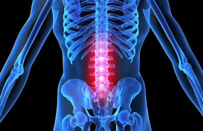 Osteochondrosis an réigiúin lumbar