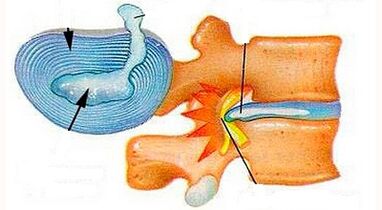 Gnéithe d'fhorbairt osteochondrosis ceirbheacs