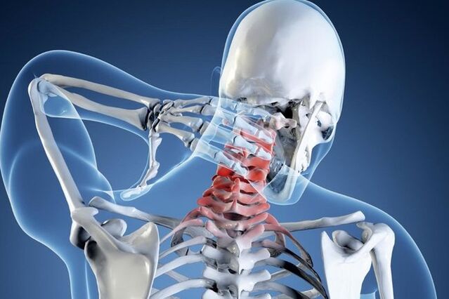 osteochondrosis an spine cheirbheacsach